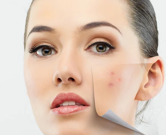 Acne & Acne Scars