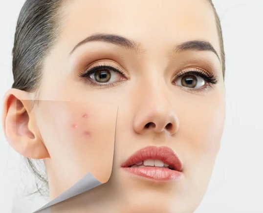 Acne & Acne Scar Treatment - Image 1